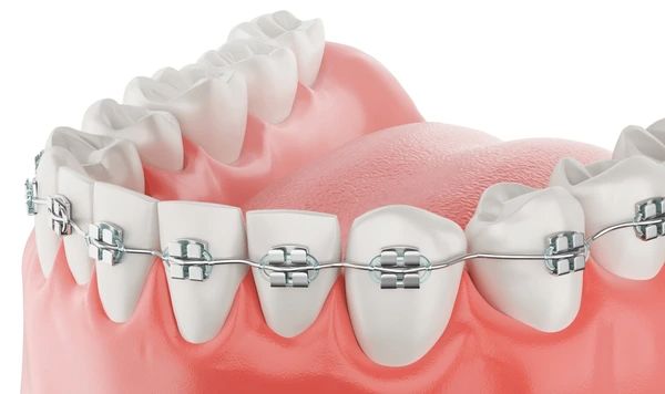 braces care braces in morton grove