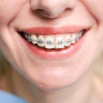 Adult Orthodontics Improves Oral Health