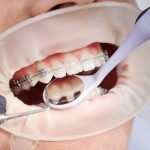 Angel Aligners