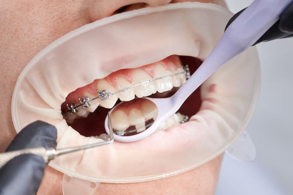 Angel Aligners